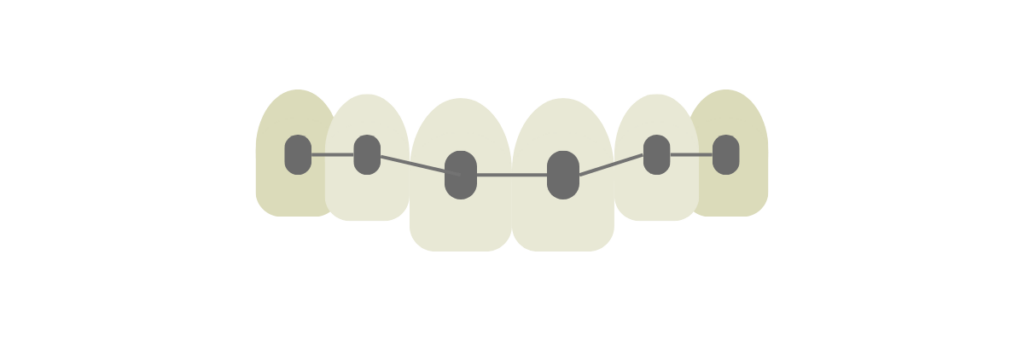 metal braces on teeth graphic - Stella Dental Practice - Stafford