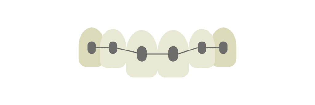 a graphic of metal braces on teeth - Stella Dental Practice - Stafford