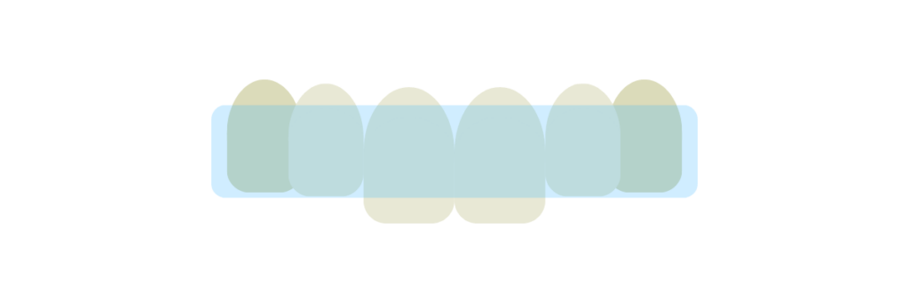 what Invisalign looks like over teeth graphic - Stella Dental Suite, Stafford, Staffordshire