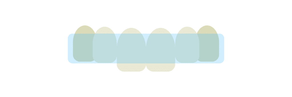 a graphic that shows what Invisalign looks like over teeth - Stella Dental Suite, Stafford, Staffordshire