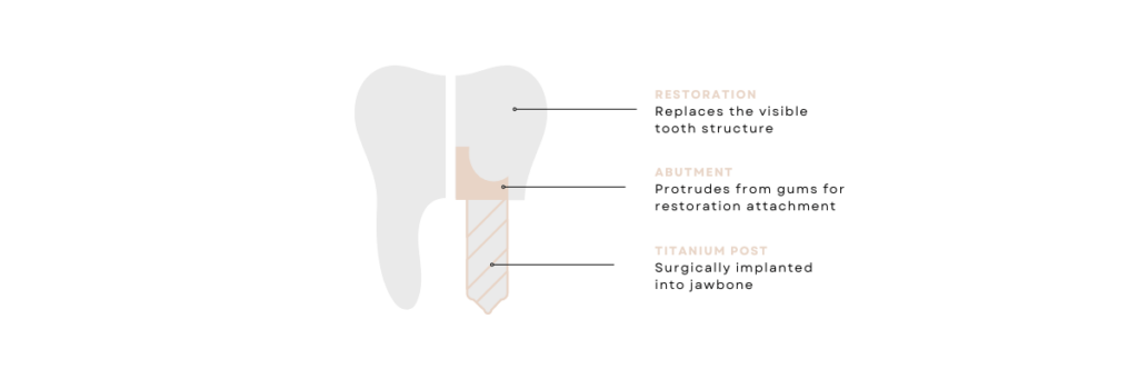 Dental implants structure infographic Restoration - replaces the visible tooth structure Abutment - protrudes from gums for restoration attachment Titanium post - surgically implanted into jawbone - Stella Dental, Stafford