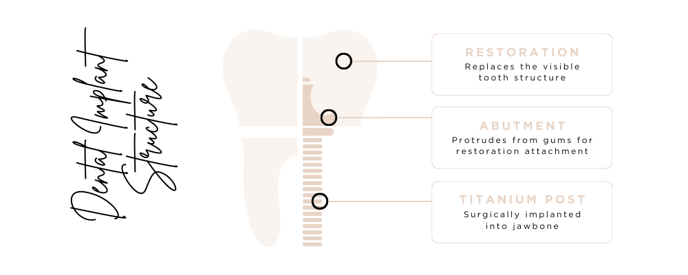 Dental implant structure inforgraphic stating as follows; Restoration - replaces the visible tooth structure Abutment - protrudes from gums for restoration attachment Titanium post - surgically implanted into jawbone - Stafford Dental Practice