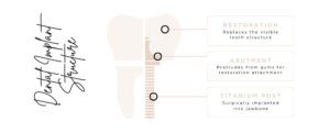 Dental implant structure - Stafford Dental Practice