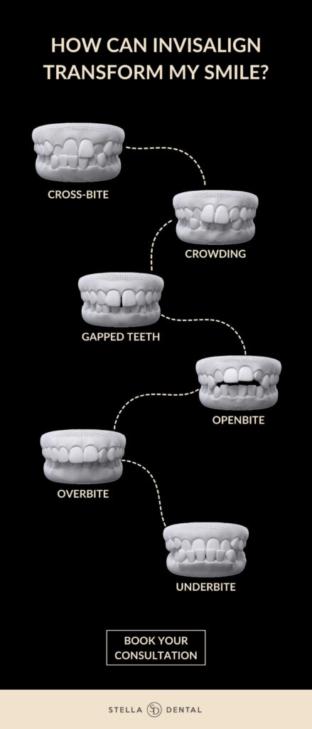 Invisalign Infographic showing what can be fixed with Invisalign, as follows: crossbite, crowding, gapped teeth, open bite, overbite and underbite. Invisalign in Stafford 