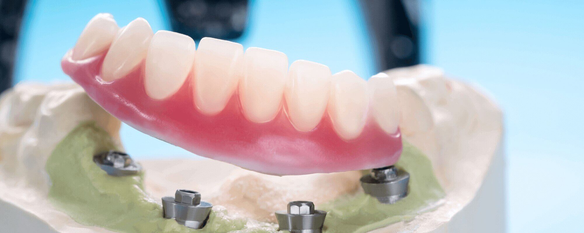 An implant-retained denture half on a model of fake gums, showing the metal screws that would be in a person's jawbone.