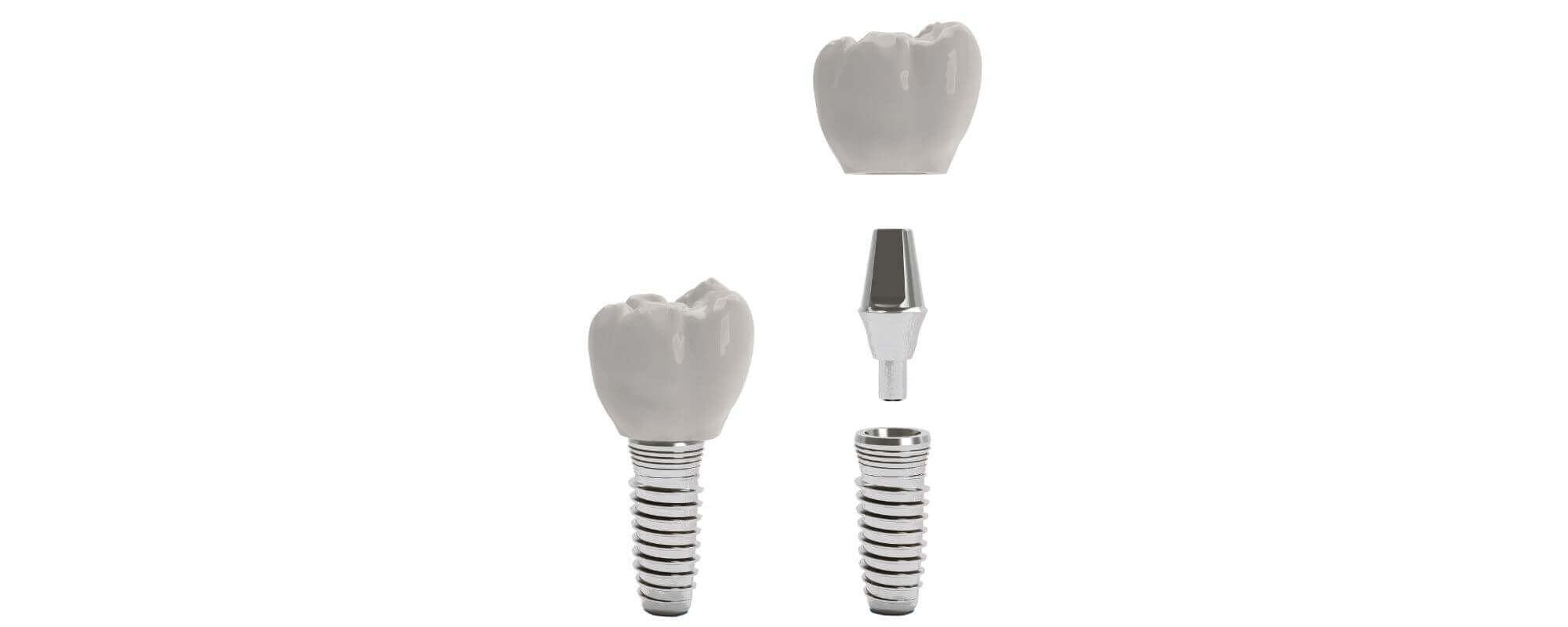 Dental implants from Stella Dental in Stafford