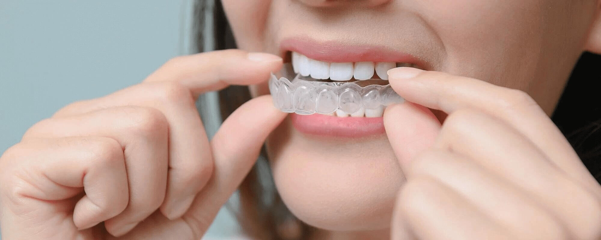 Woman putting in one of her Invisalign trays.