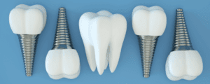 An image showing what dental implants look like on their own.